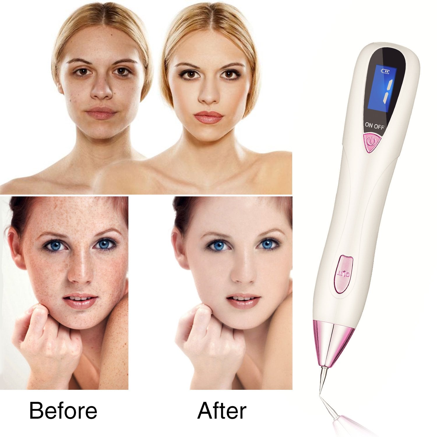 Skin Tag Remover Pen - 9 Levels Portable Mole Removal Kit, Home Use Tag Buddy Beauty Tool Set, FDA Cleared Device